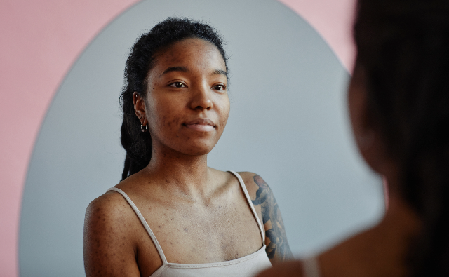 Black woman with acne scars